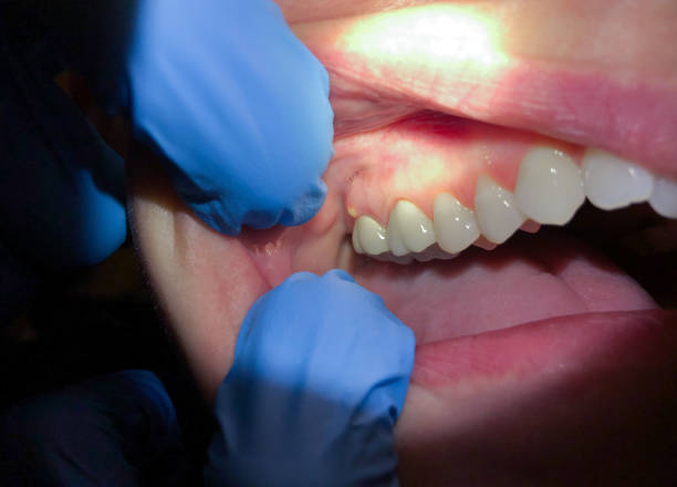Best Emergency Wisdom Teeth Removal in Lambertville, MI